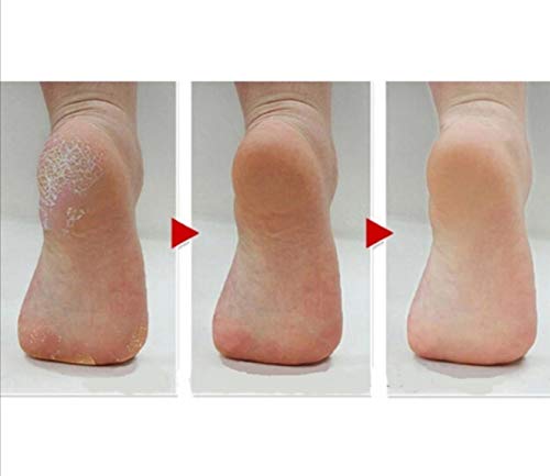 ESFOLIADOR E REMOVEDOR DE CALOS ELETRONICO LIXA DE PÉ PORTATIL PEDICURE