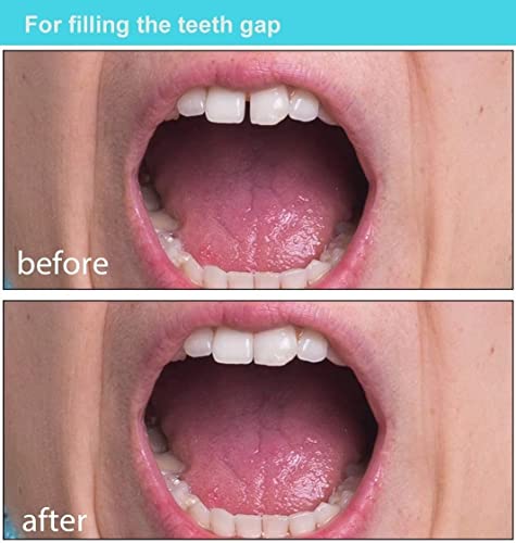 Womcare Temporary Tooth Repair Kits For Filling The Missing Broken Tooth And Gaps-Moldable Fake Teeth And Thermal Beads Replacement Kits #TOP3