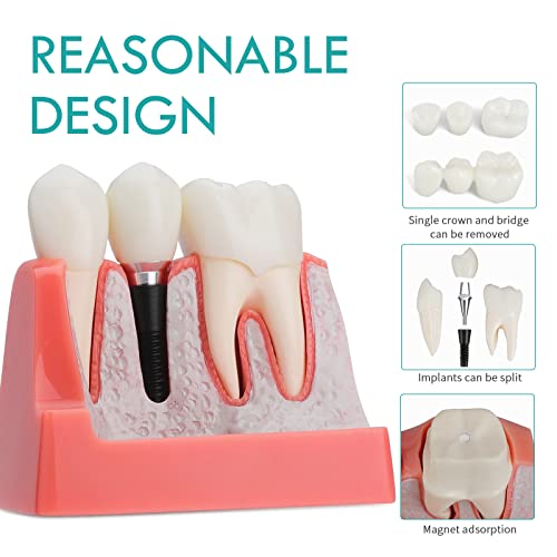 Lvchen Dental Implant Model - 4 Times Crown Bridge Explanation Model Implant Analysis Tooth Model Removable Crown Cross-Section Demonstration For Study And Teaching #TOP1