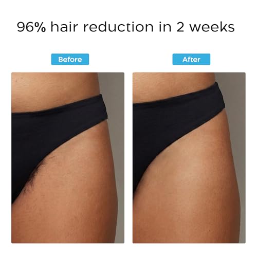 Image of Lorentis IPL laser Hair Removal Device - FDA Approved, Painless & Permanent Hair Reduction for Women & Men - Unlimited Flashes for Face, Body & Bikini - 2 Year Warranty