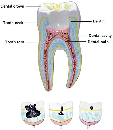 Modelo Dental - Tallada Herramientas De Demostración Modelo De La Caries Dental como Un Modelo De Aprendizaje O Una Herramienta De Investigación