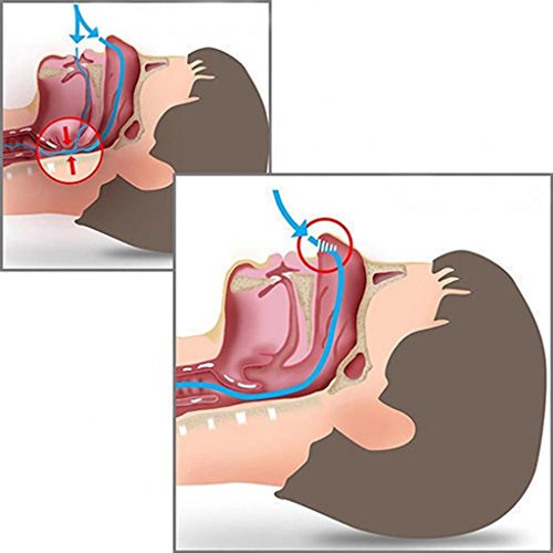 Dilatador Nasal Anti Ronco E Apnéia Do Sono Clip Nasal