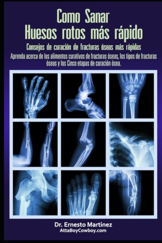 Como curar huesos rotos más rápido. Consejos para curar fracturas de huesos: Aprenda sobre los alimentos para la curación de fracturas, los tipos de ... etapas de curación. (Health and Wellness)