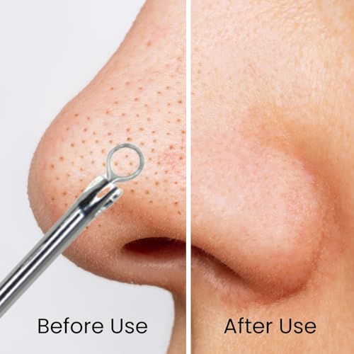 Image of Midazzle Round Blackhead & Whitehead Remover Tool, Stainless Steel Pimple & Acne Extractor Tool for Clean Pores & Clear Skin | Face Care Tool for Men & Women, All Skin Types (MIBR3301)