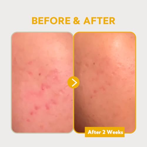 image for TIRTIR Pure Vitamin C 24% Face Serum – Dark Spot Remover for Sensiti