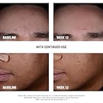 Neutrogena Stubborn Blackheads Daily Acne Facial Serum with Salicylic, Glycolic, Polyhydroxy & Mandelic Acids, Oil-Free Face Serum for Acne-Prone Skin to Help Clear Clogged Pores, 1 fl. oz - Image 3