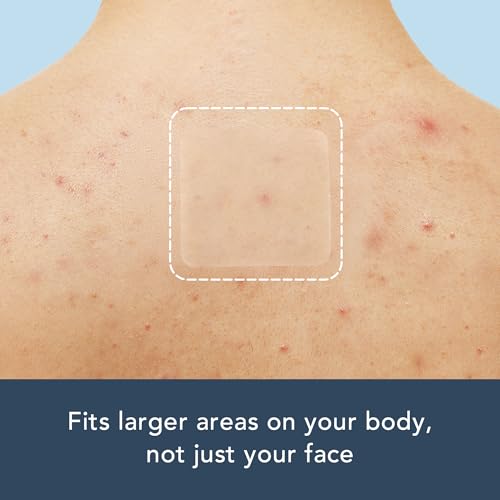 Rael Pimple Patches, Miracle XL Spot Control Cover - Hydrocolloid Acne Pimple Patch for Face, Zits & Blemish, Back and Body, Korean Skin Care (8 Count)