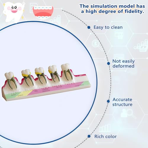 Image of Periodontal Disease Classification Model, 5-Stage Dental Anatomy Model for Dental Education,Dental Training,Demonstrations,Oral Care Education
