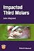 Impacted Third Molars