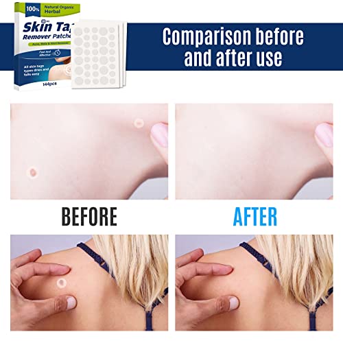 Skin Tag Removal Patches, 144Pcs Skin Tag Remover, Advanced Natural Herbal Formula Wart Remover For Face And Body - 4