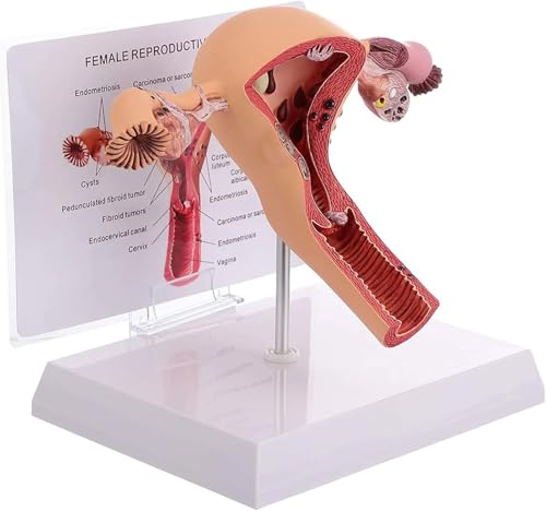 Modèle de pathologie utérine et ovarienne AMITD pour anatomie