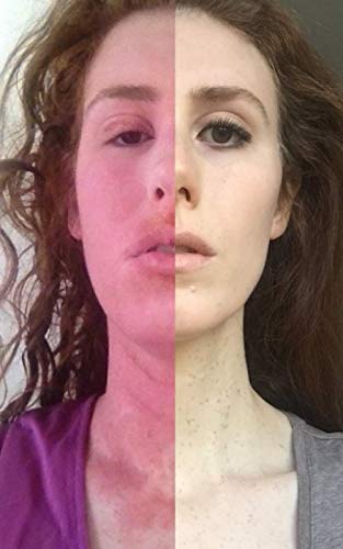 Preisvergleich Produktbild Curing my Incurable Eczema