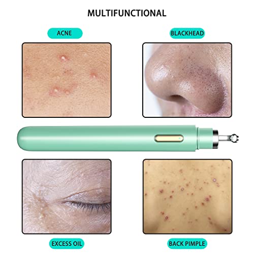 image for womfenn Visible Blackhead Remover[2022 New], Advanced Pimple Popper wi
