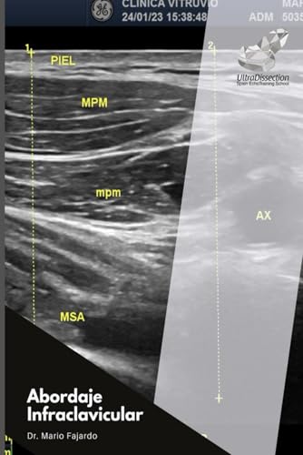 Abordaje Infraclavicular (Spanish Edition)