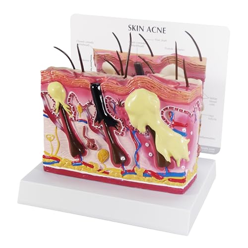 GPI Anatomicals - Skin Acne Model, Cross-Section Showing Normal and Common Acne-Riddled Skin for Human Anatomy, Physiology Education, Anatomy Model for Doctor's Office, Medical Learning Resources