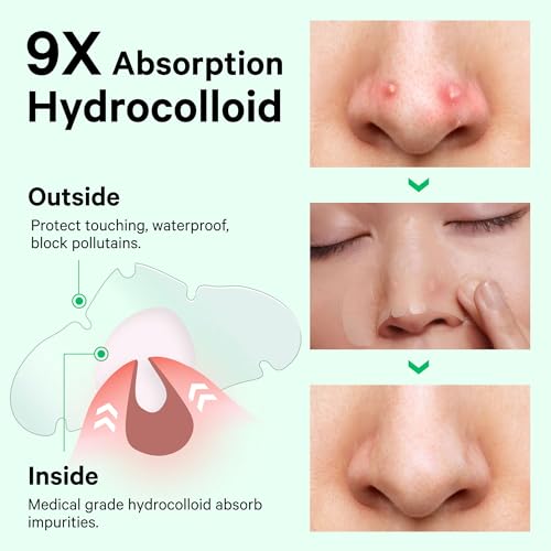 Image of Sosky Patches for Nose Overnight Acne Pore Strips Hydrocolloid Nose Patches Helps Control Oil, Targets Pimples & Blemishes, Clear Skin 10 Count