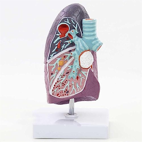 Modelo de cáncer de pulmón 2:3 para estudios e investigaciones médicas 5