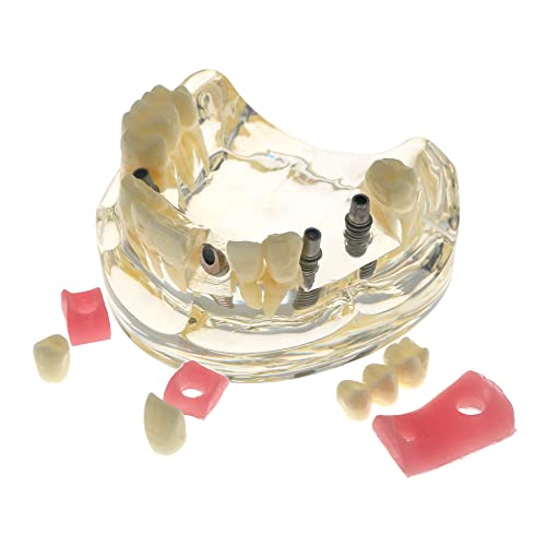 Dental Implant Teeth Model Demo 4 Implants Bridge Abutment Overdenture Typodont Restoration Study Teach Demo Soft Gingivae Crowns (M2005) #TOP5