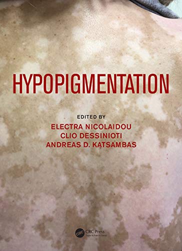 Hypopigmentation view 2