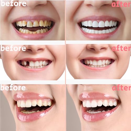 Image of 2 Pairs Temporary Smile Support Adjustable for All Genders, Top and Bottom, Temporarily Adjustable for Men and Women, Regain Confidence