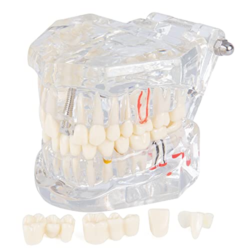 bcenyaz Modelo de dientes de implante dental transparente - Modelo de dientes de enfermedad transparente Modelo de dientes patológicos con dientes extraíbles para estudio y educación dental Cover