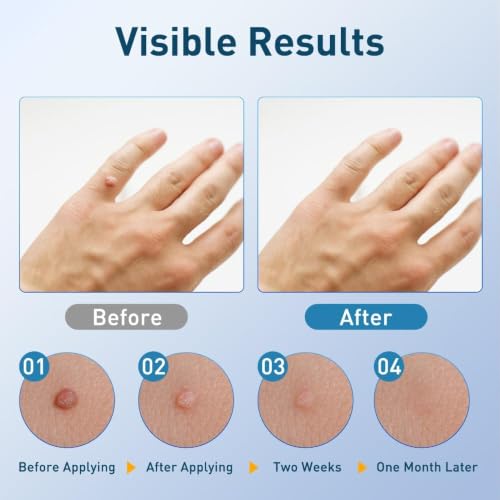 Image of Wart Remover Liquid for Body - Salicylic Acid Serum with Precise Applicator, Removal Plantar Wart, Gentle Natural Herbal Formula for All Skin Types (2)