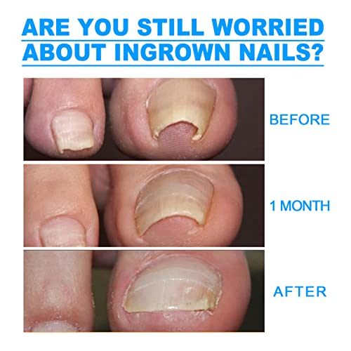 6 peças/caixa adesivo de unha encravada adesivo corretivo de unhas ferramenta de cuidados com os pés