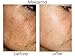 Planet Eden 70% Glycolic Acid Skin Chemical Peel Kit with Treatment Fan Brush- Professional Strength for Sun Damage, Dark Spots, Wrinkles,Enlarged Pores