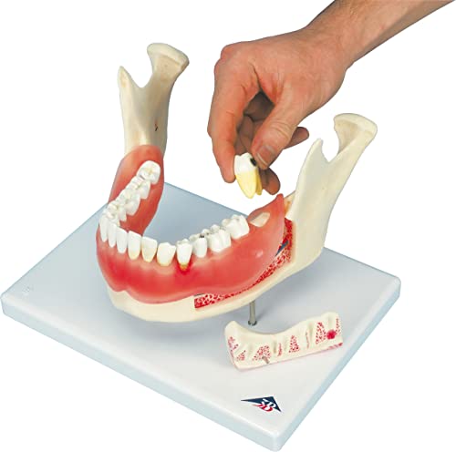 Image of 3B Scientific D26 Dental Disease 2x magnification 21-parts - 3B Smart Anatomy