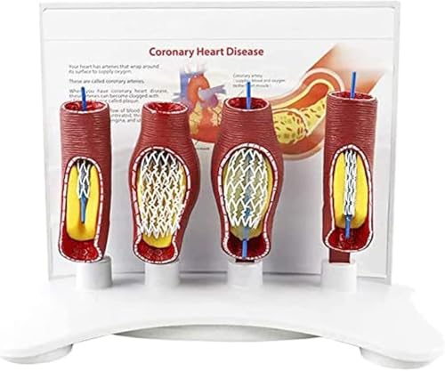 Modèle de stent vasculaire humain : solution pour enseigner le blocage