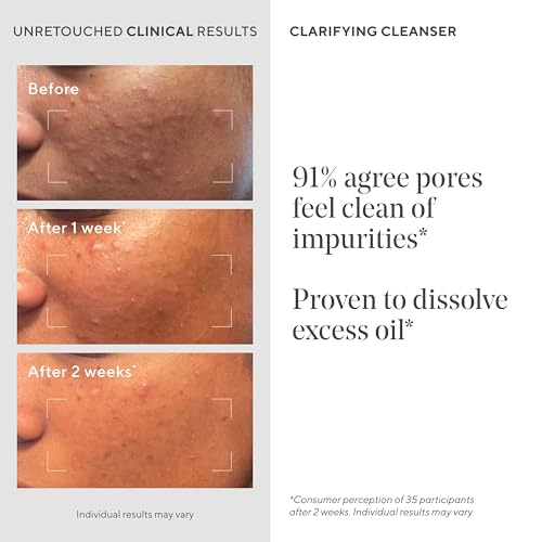 Murad Clarifying Cleanser – Salicylic Acid & Green Tea Formula for Acne, Deep Pore Cleansing, Oil Control & Breakout Prevention for Clear, Balanced, Healthy-Looking Skin – 5 Fl Oz