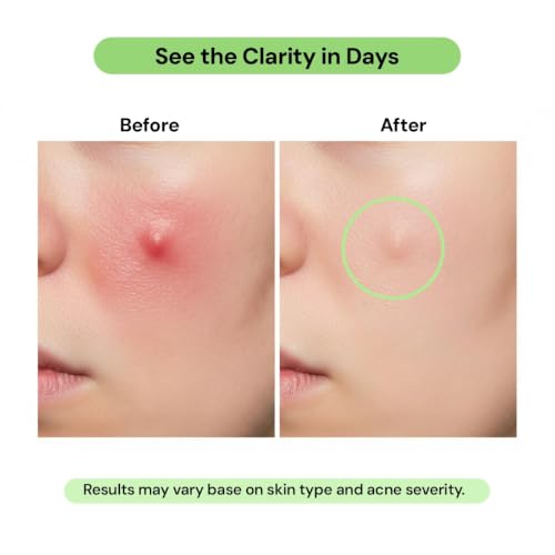 Image of Acne Dot Gel for Acne & Pimples Spot Treatment | Enriched with Acne Buster, 1% Salicylic Acid, Azelaic Acid & Niacinamide | Helps Reduce Active Breakouts, Redness, Acne Marks & Blemishes | 25g (Pack of 3)