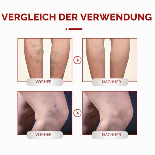 Varicose Veins Cream by Boxiatil - image 5