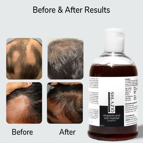 Image of Shlazio Professional Anti Hair Fall Shampoo for Alopecia | Strengthens Hair & Nourishes Scalp | 300 ml
