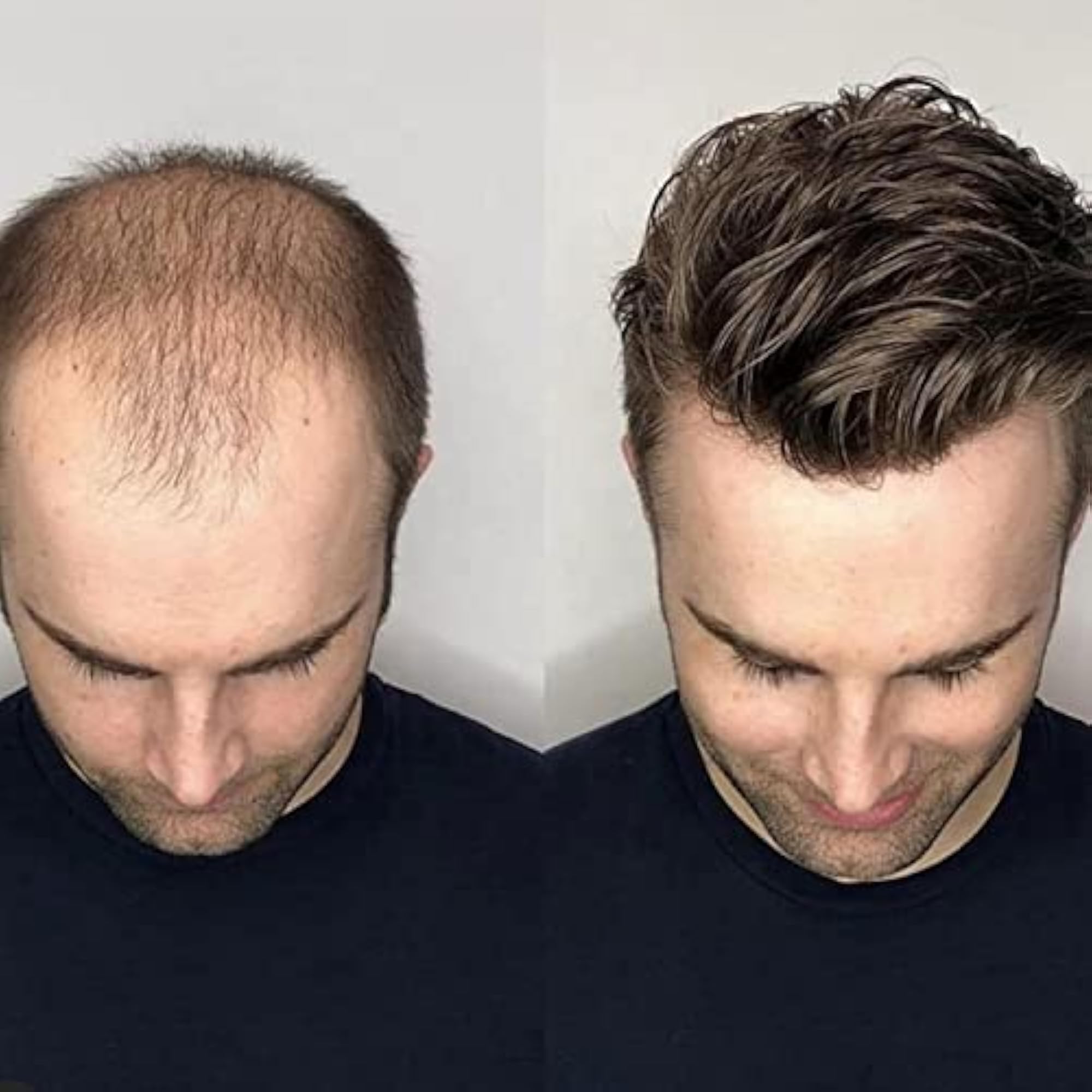 Australian Hair Patch for Men, 100% Human Hair