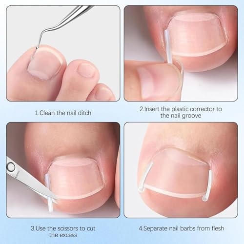 Professional Ingrown Toenail Corrector Kit, with Curved Toe Nail Correction Strips and Breathable Corrector Patch, Painless Ingrown Toenail Tool, Pedicure Tools Set for Women & Men