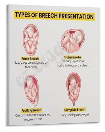 Clinical Breech Guide Poster Types of Breech with Illustrations for Medical Office and Teaching Hospital Decor(Unframed,08x12inc
