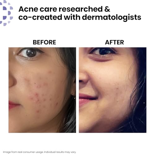 Image of Kaya Acne Care Purifying Face Wash with Salicylic Acid | Dermatologist-Developed Cleanser with 22 Years of Expertise | Fights Pimples, Reduces Acne & Controls Oil | For Oily & Acne-Prone Skin | Men & Women | 100ml