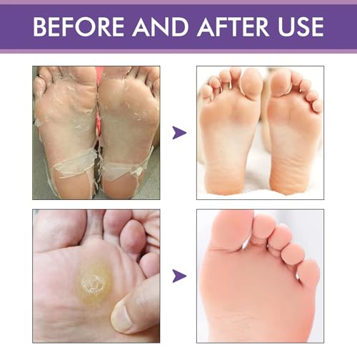 5 Pares de Máscaras Hidratantes de Pies, Máscara para Pelar Los Pies, Calcetines Exfoliantes para Los Pies, Mascarilla Exfoliante de Pies, Restaurar los Pies Suaves Del Bebé, para Hombres y Mujeres - imagen 6