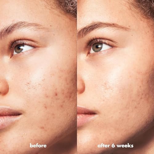 e.l.f. SKIN Blemish Breakthrough Triple-Acid Resurfacing Serum Mini, Hydrating Night Serum For Fighting Blemishes, Helps Improve Skin Tone & Texture - image 4