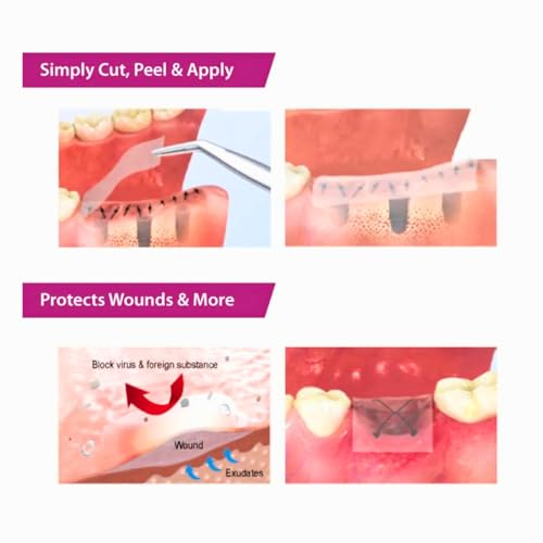 Image of Ora-Aid Intra-Oral Wound Dressing Red - 25x15mm (AG-202A) | Attachable Oral Protective Barrier | Sterile & Adhesive | Post-Surgical & Ulcer Care
