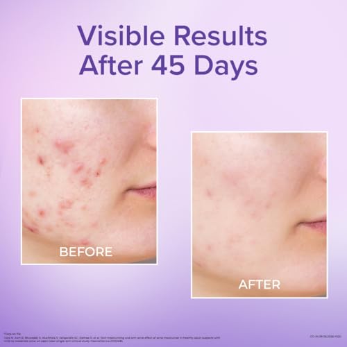 Image of Dr. Reddy's Venusia Acne Moisturizing Gel For Oily & Acne Prone Skin | Ultra-light Sebum Control Formula With 5%+ Hydrating Complex, Polyglutamic Acid, 4-D Hyaluronic Acid and Ceramide | Advanced Care For Clear, Balanced & Healthy Skin | Unisex Face Gel | 60 gm