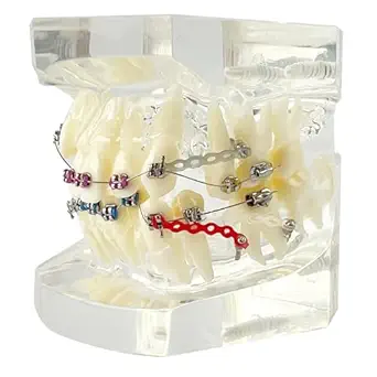 Orthodontic Demonstration Model with Stainless Steel Brackets and Colorful Ligatures - Misaligned Teeth Correction Display on Transparent Acrylic Base - Ideal for Educational and Training Purposes