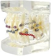 Orthodontic Demonstration Model with Stainless Steel Brackets and Colorful Ligatures - Misaligned...