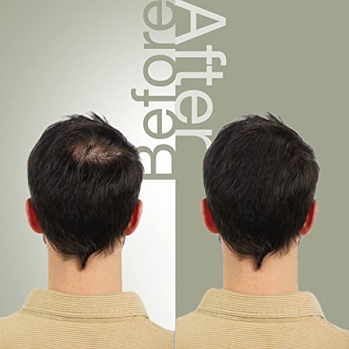 The Mossi London Hair Repair Set , Hair Growth Set With Hair Thinning Shampoo And Proskin Hair Mousse Volumizing Fine Hair , Hair Regrowth Treatment For Men With Biotin , Panthenol And Procapil , After Hair Transplant #TOP3