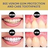 Bienengift Zahnpasta,Bienengift Zahnfleischpflege Zahnpasta Tiefenreinigung Zahnstein Flecken Zahnstein Geruch Frischer Atem Whitening Zahnpasta (2)