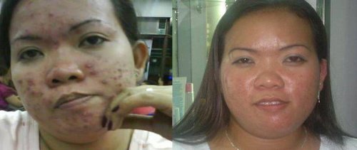 glutathione and parksinsons disease Dr. Joseph C. Maroon is a neurosurgeon and a professor at the University of  Pittsburgh Medical Center. His research on Alzheimers and Parkinsons  disease focuses on the role of oxidative stress and