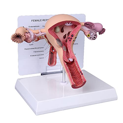 Noblelady Pathological Uterus Ovary Model, Human Anatomical Model Female Reproductive Organ Model for School Teaching Demonstration Tool