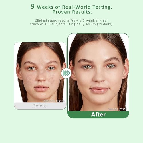 VBBV Dark Spot Remover for Face & Body – Dark Spot Corrector Serum for Hyperpigmentation, Brown Spots & Melasma Treatment - 1.7 fl oz