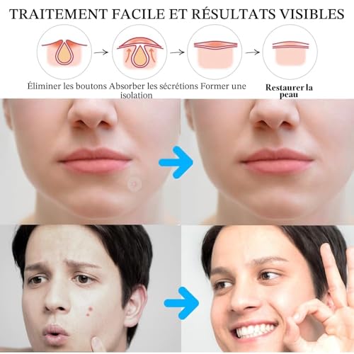 600PCS Patch Boutons Acne Pimple Anti-Acné Invisible Imperméable – vue 7